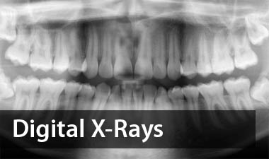 Teeth in digital X-rays.
